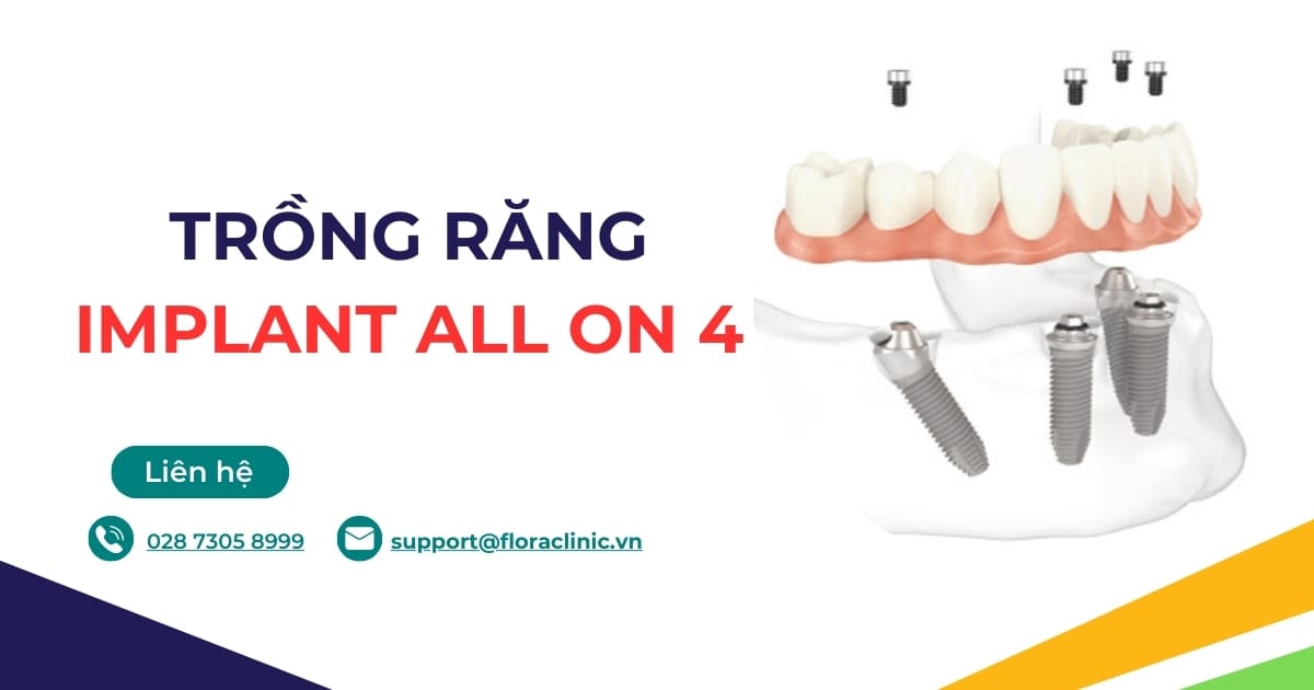 Trồng răng implant All on 4 có tốt không? Giá bao nhiêu?