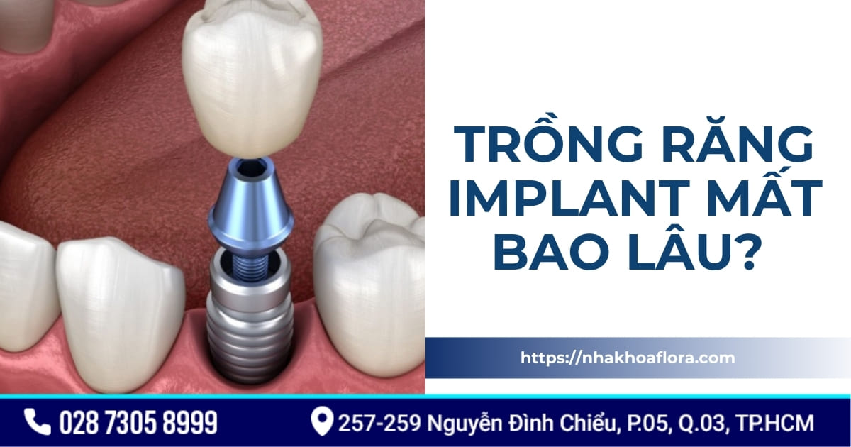 Trồng răng implant mất bao lâu thì xong? Có lâu không?