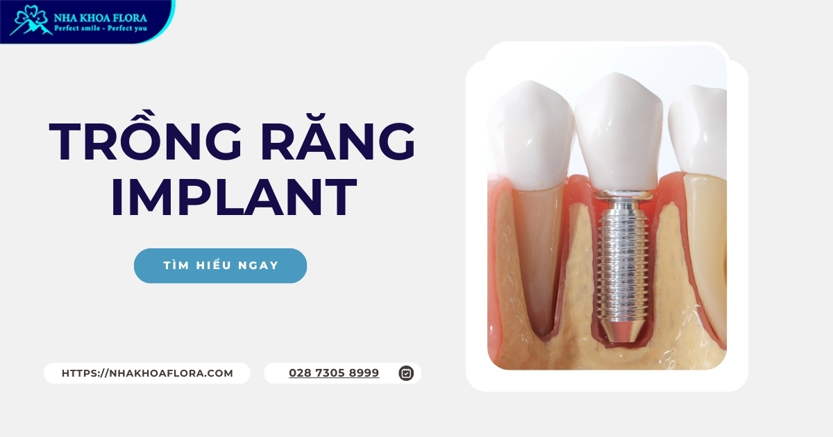 Kỹ thuật cấy ghép Implant là gì? Có an toàn và hiệu quả không?