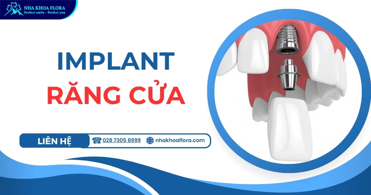 Implant răng cửa là gì? Có tốt không? Giá bao nhiêu?