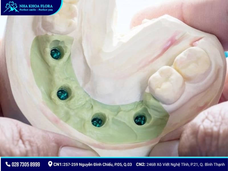 lấy dấu implant