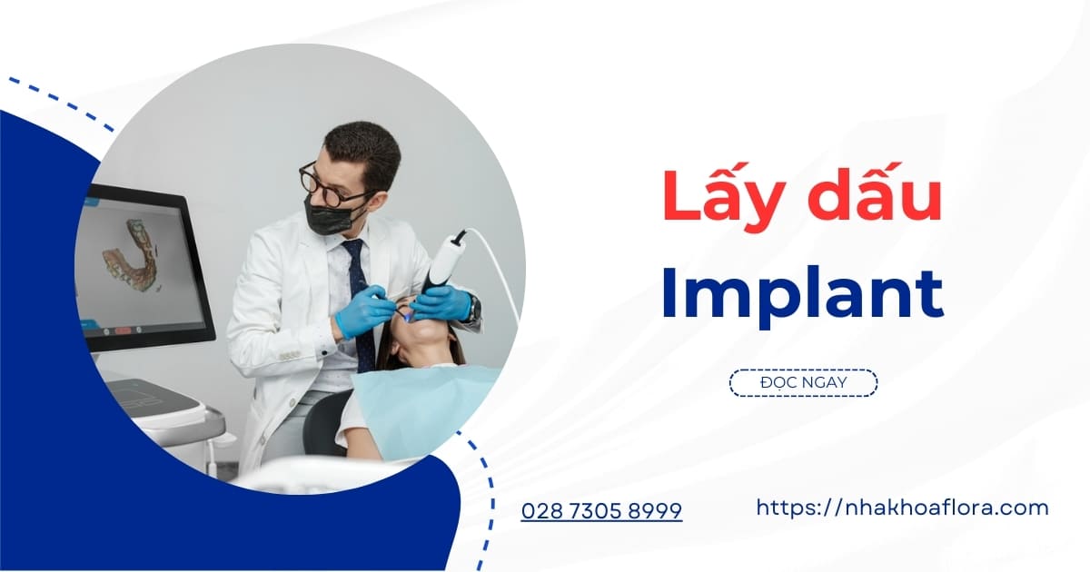 Lấy dấu Implant là gì? Vai trò và quy trình thực hiện chuẩn