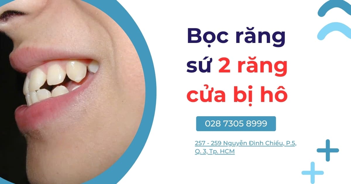 Bọc răng sứ 2 răng cửa bị hô có được không? Giá bao nhiêu?