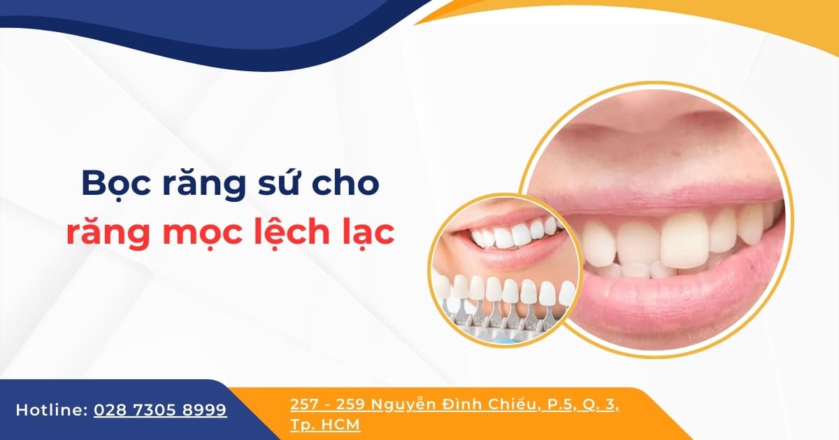 Bọc răng sứ cho răng lệch lạc có được không? Giá bao nhiêu?
