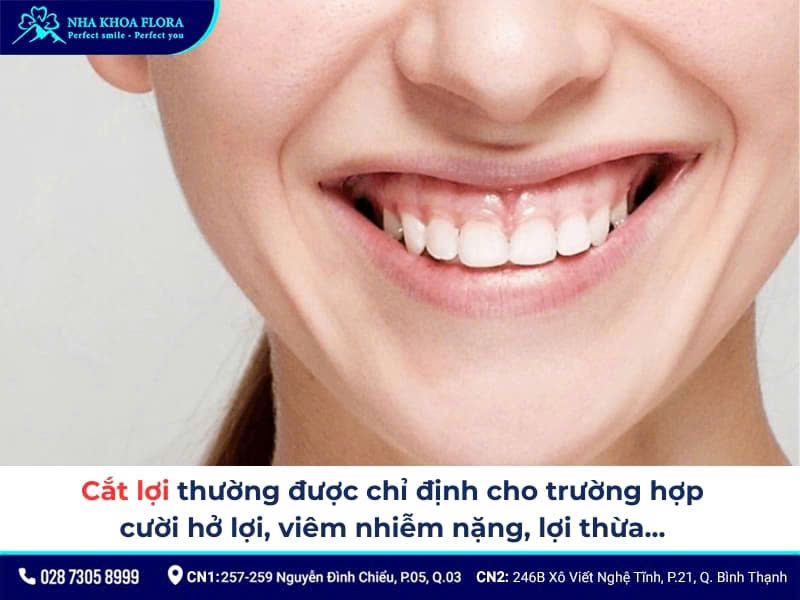cắt lợi