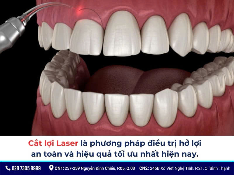 cắt lợi