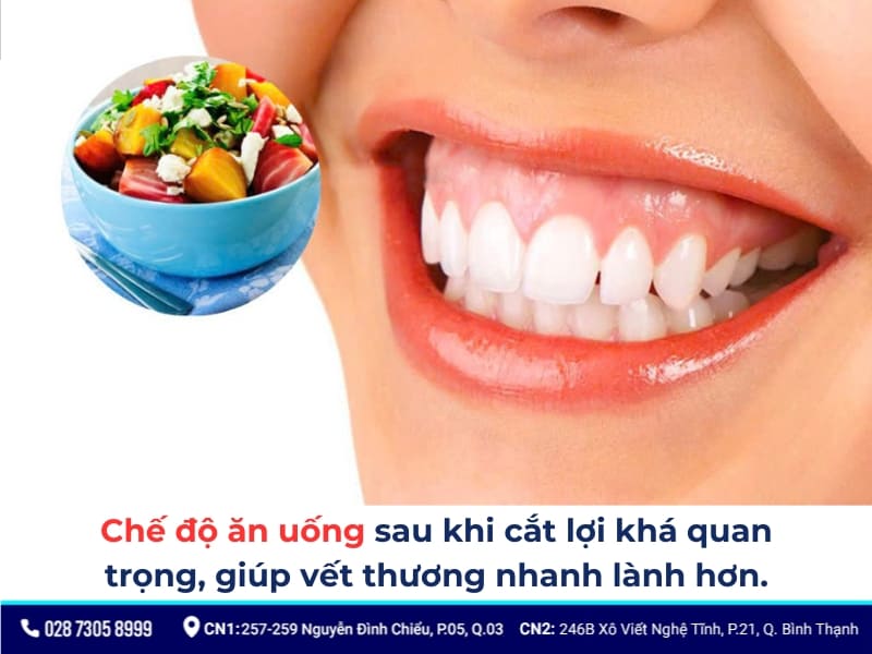 cắt lợi laser