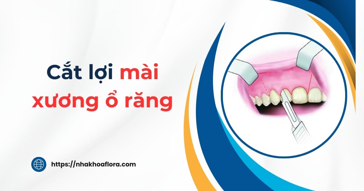 Cắt lợi mài xương ổ răng là gì? Có đau không? Giá bao nhiêu?