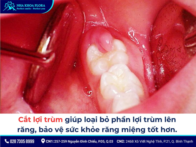 cắt lợi trùm
