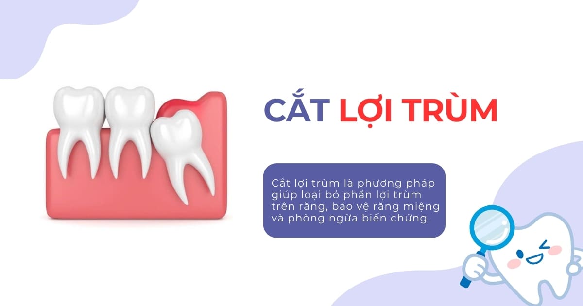 Cắt lợi trùm là gì? Có đau không? Chi phí bao nhiêu tiền?