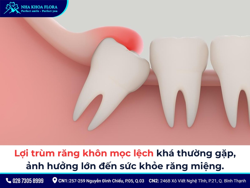 cắt lợi trùm