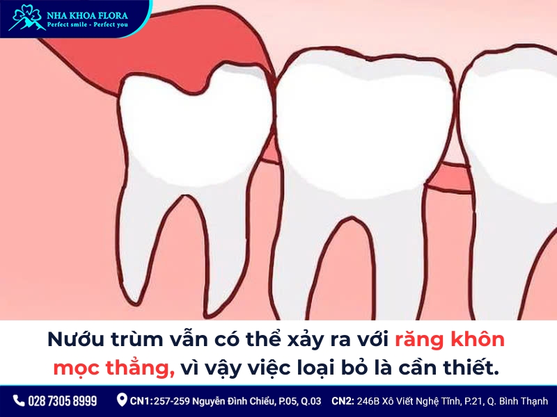 cắt lợi trùm