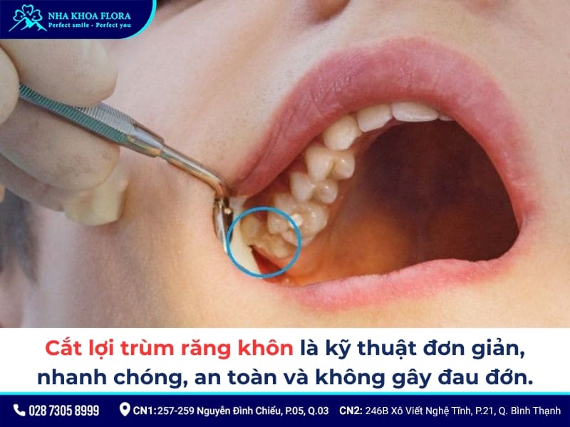 cắt lợi trùm