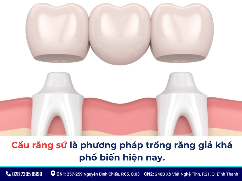 cầu răng sứ