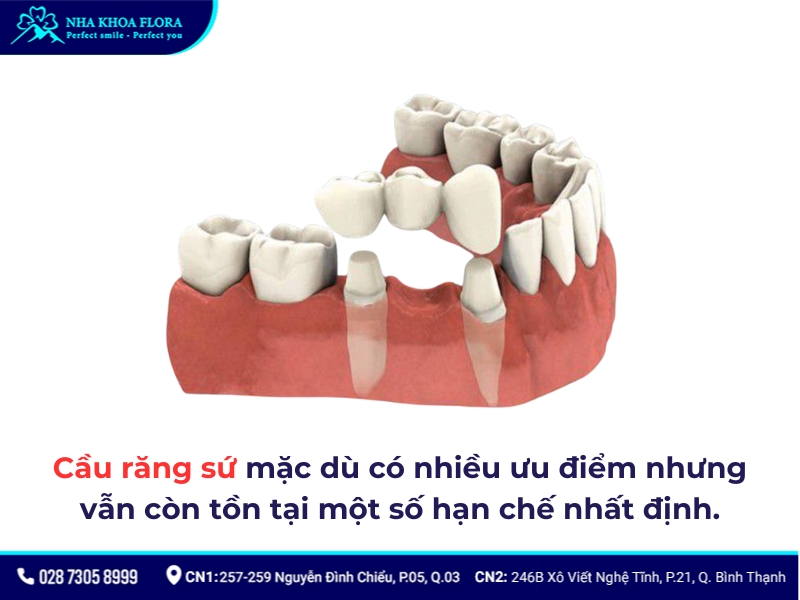 cầu răng sứ