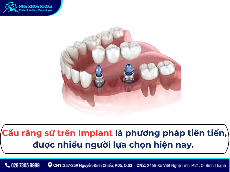 cầu răng sứ