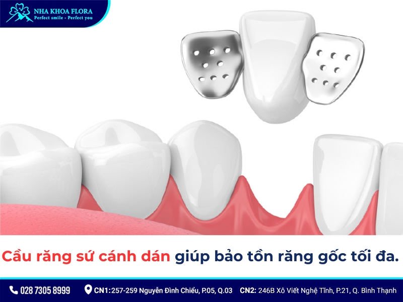 cầu răng sứ