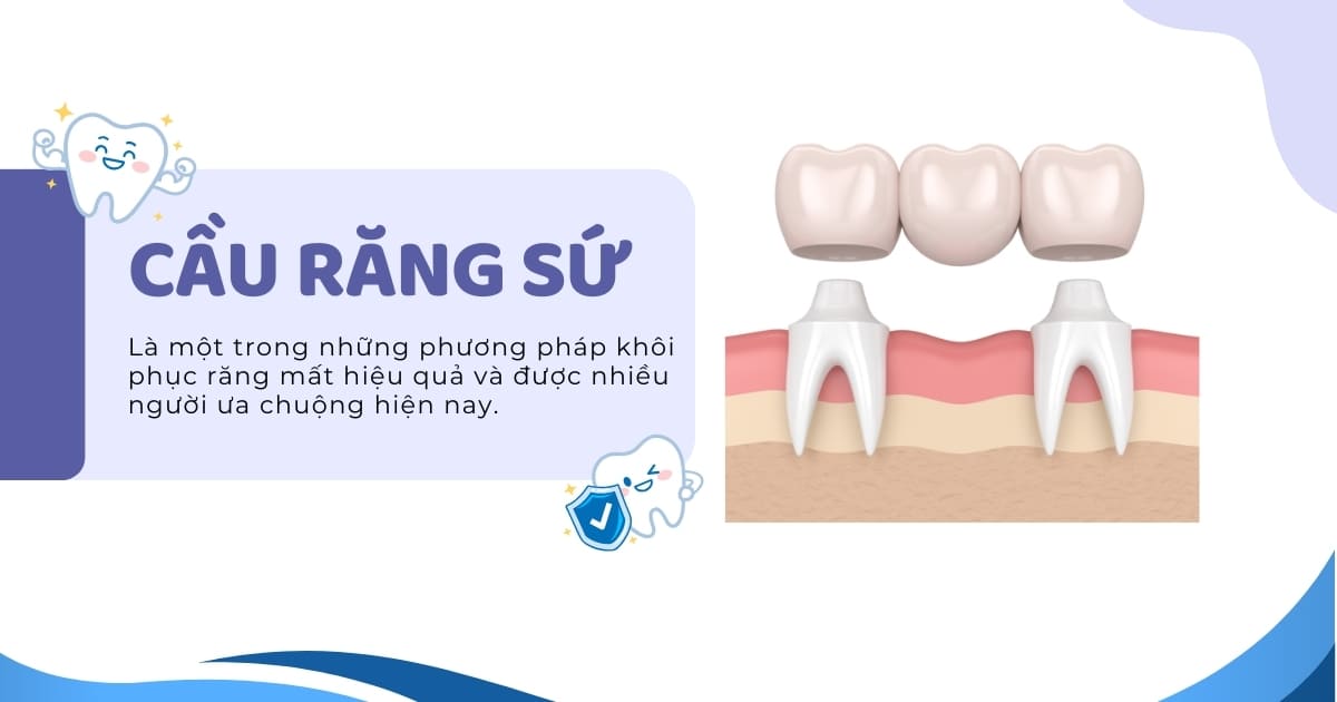 Cầu răng sứ là gì? Có tốt và bền không? Giá bao nhiêu tiền?