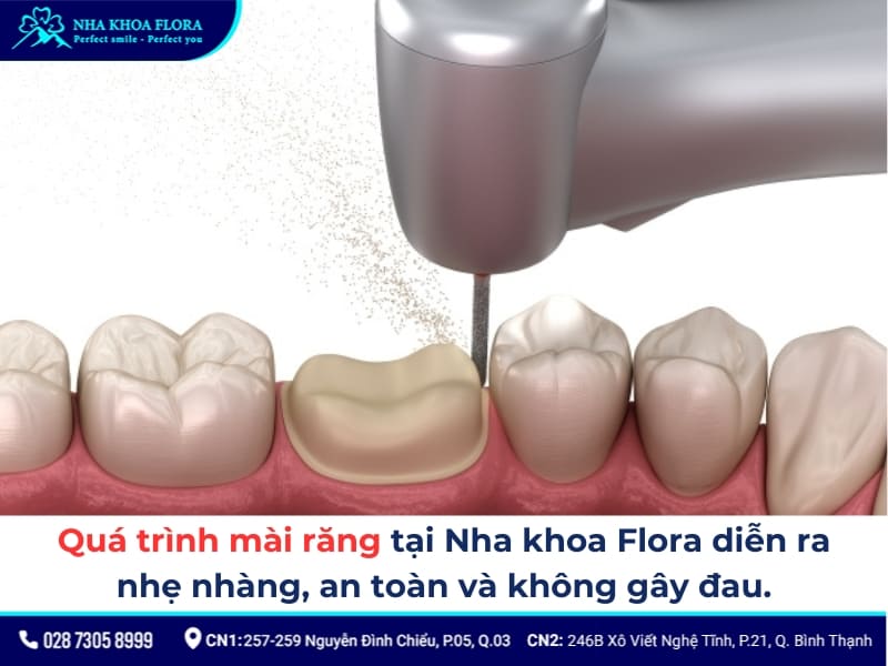 cầu răng sứ