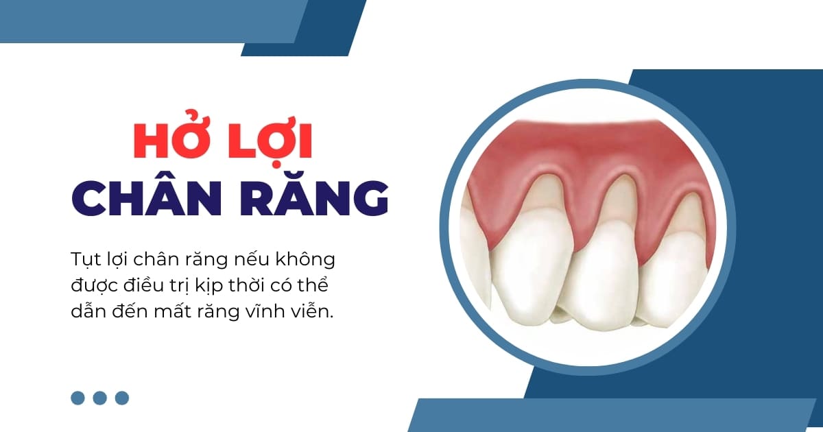 Hở lợi chân răng phải làm sao? Cách phòng ngừa thế nào?