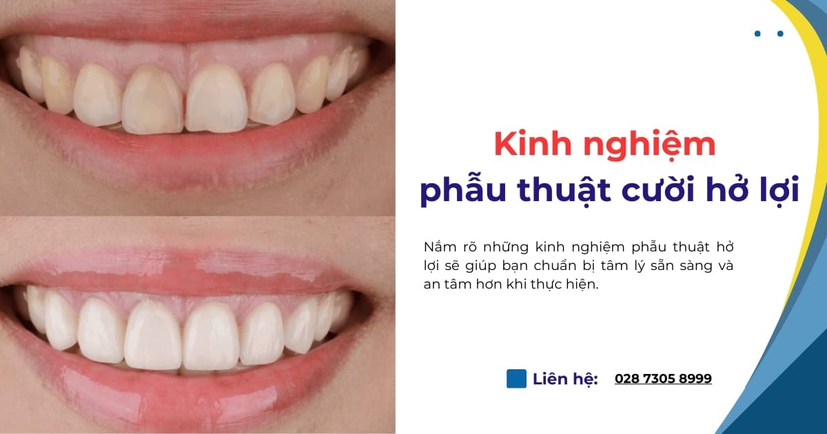 Kinh nghiệm phẫu thuật cười hở lợi bạn không nên bỏ qua!