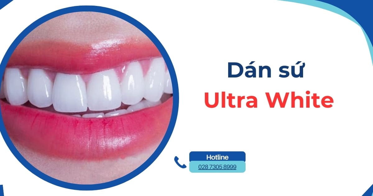 Dán sứ Ultra White có tốt hay không? Giá bao nhiêu tiền?