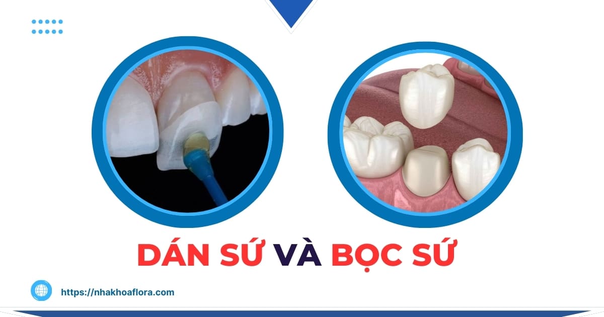 Dán sứ và bọc sứ khác nhau ra sao? Nên chọn kỹ thuật nào?