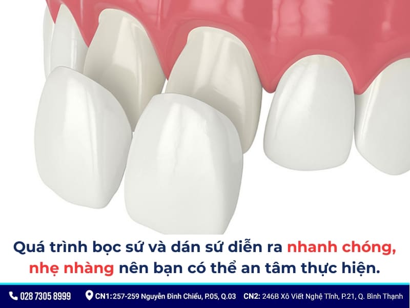 dán sứ và bọc sứ