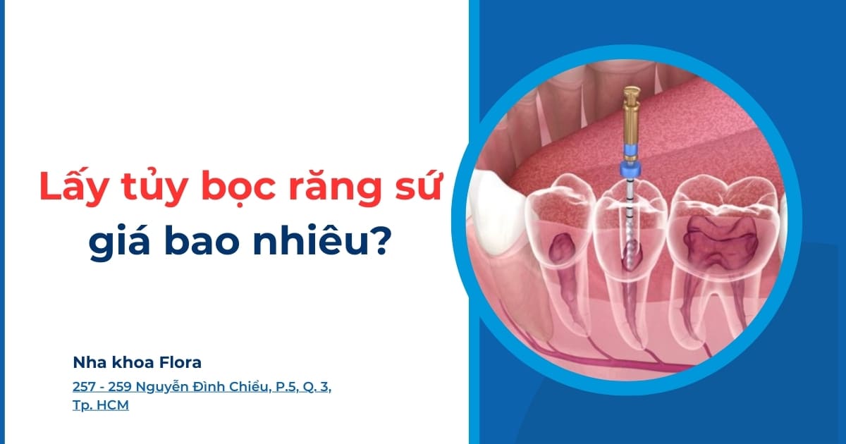 Lấy tủy bọc răng sứ giá bao nhiêu? Chi phí mới nhất 2025