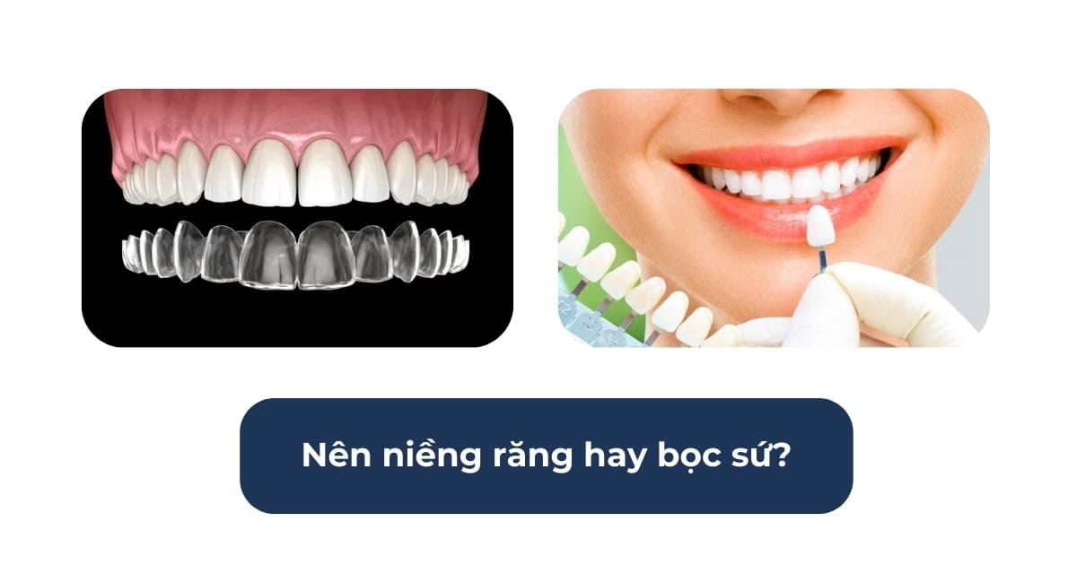 Nên niềng răng hay bọc sứ? Phương pháp nào hiệu quả cao hơn?
