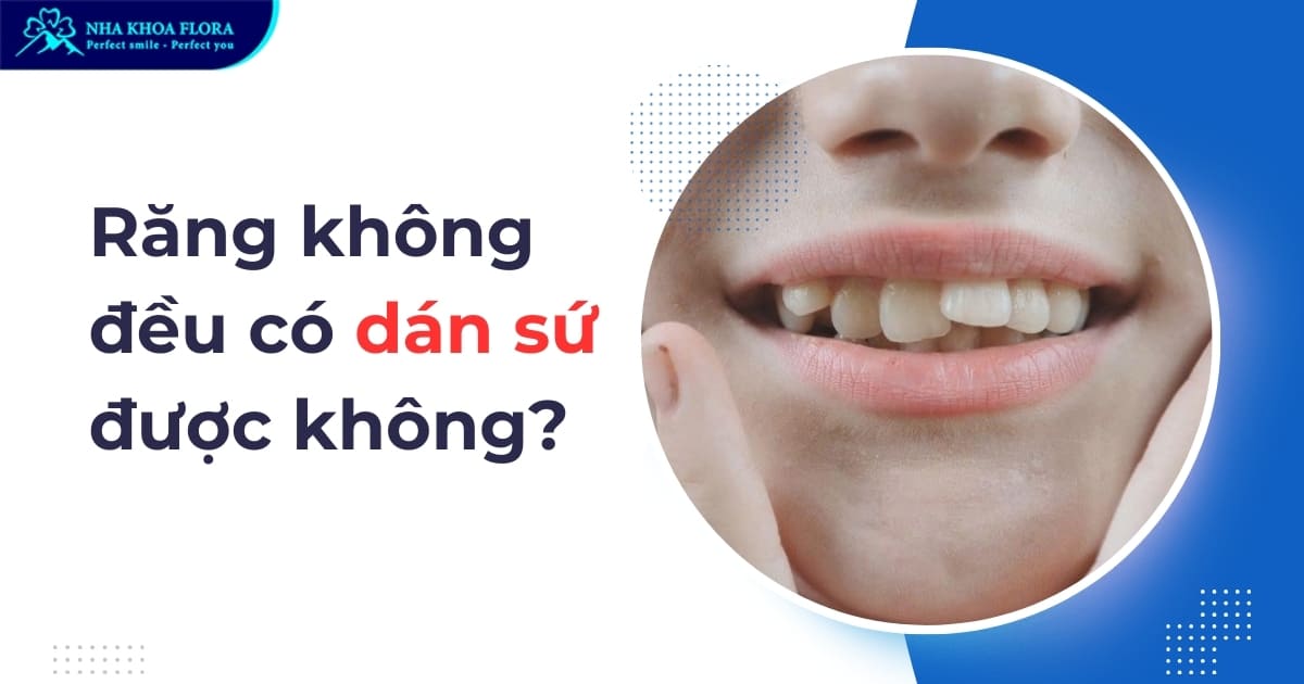 Răng không đều có dán sứ được không? Cách điều trị hiệu quả