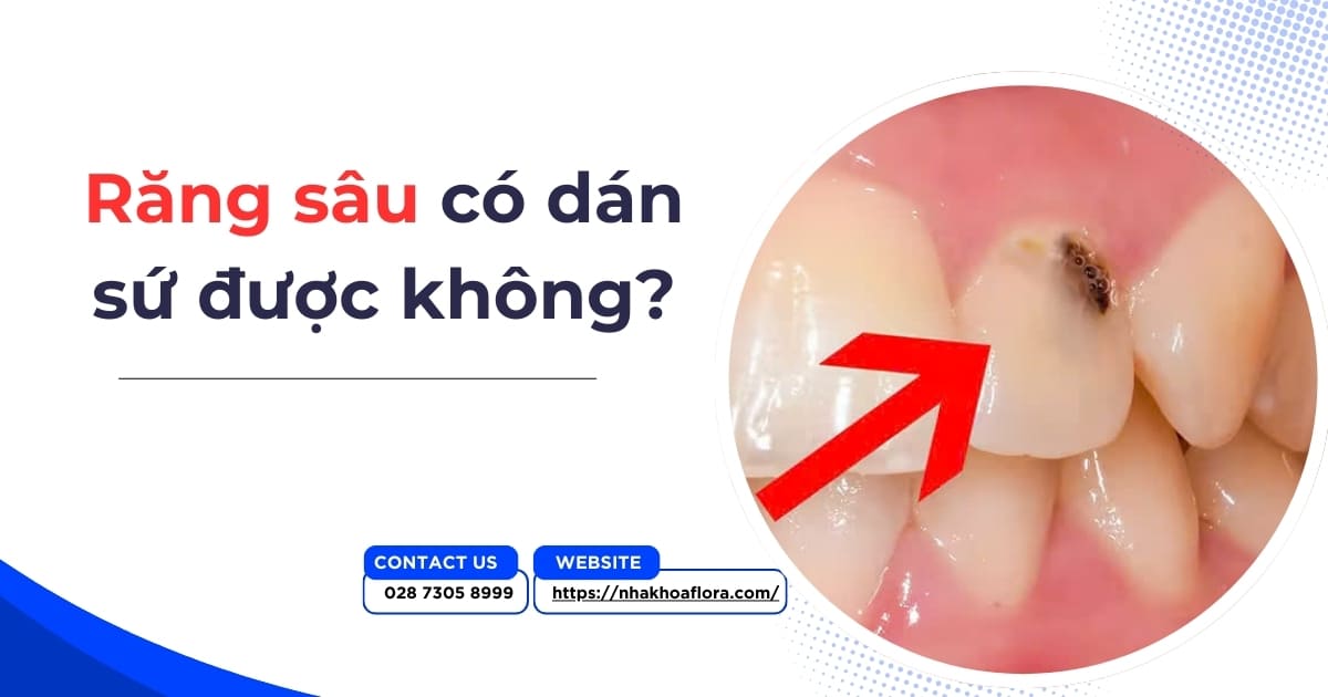 Răng sâu có dán sứ được không? Chi phí hết bao nhiêu tiền?