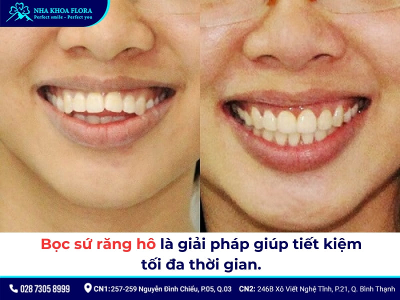 bọc răng sứ