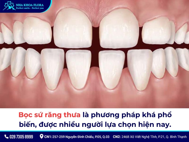 bọc răng sứ