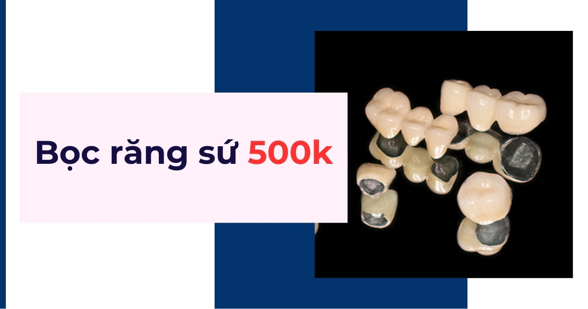 Bọc răng sứ 500k có an toàn không? Có nên lựa chọn không?
