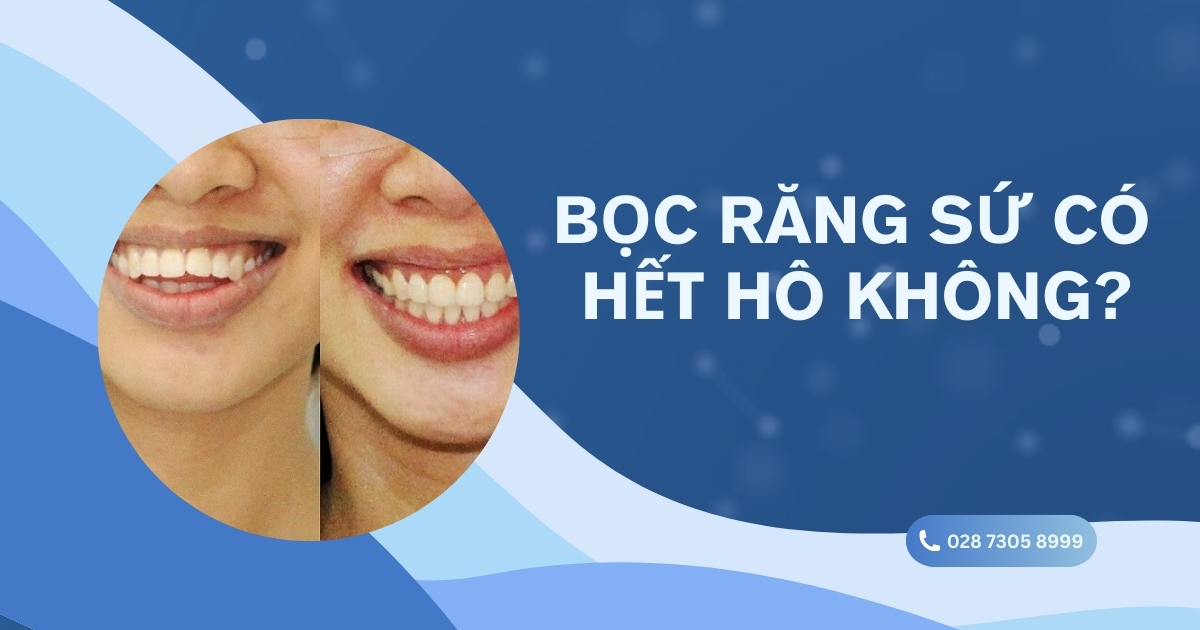 Bọc răng sứ có hết hô không? Chi phí hết bao nhiêu tiền?