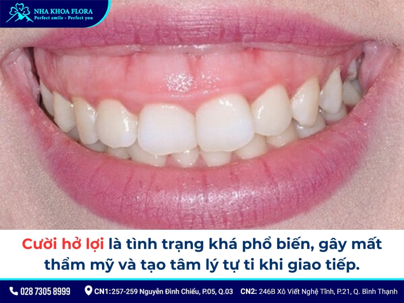cười hở lợi