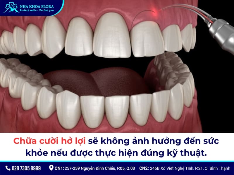 cười hở lợi