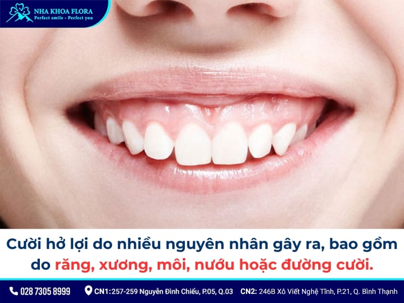 cười hở lợi