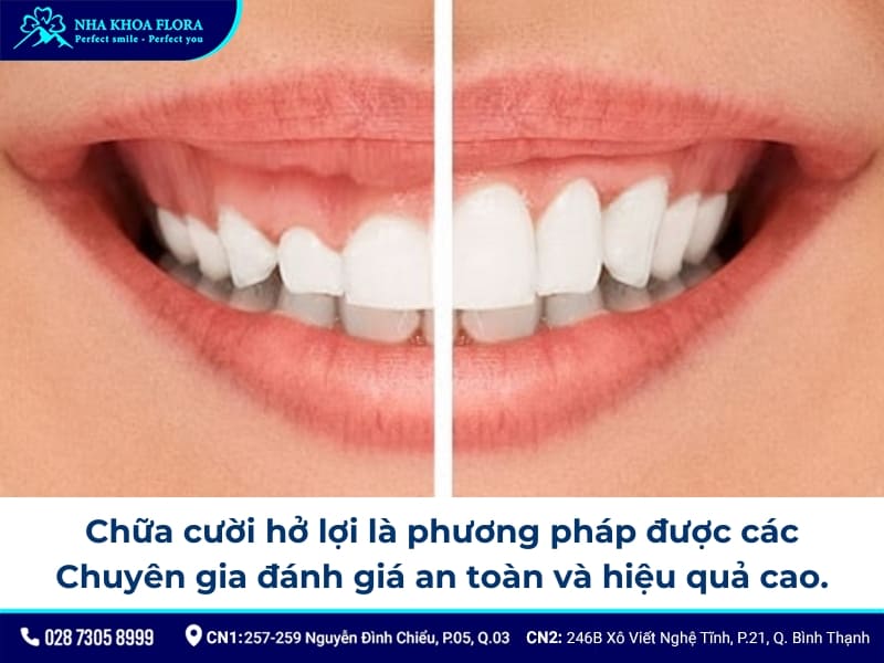 cười hở lợi