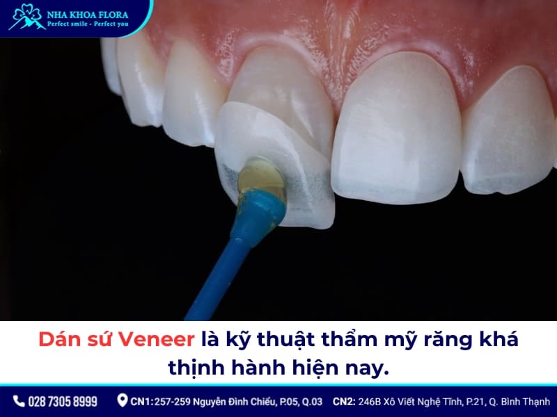 dán sứ veneer