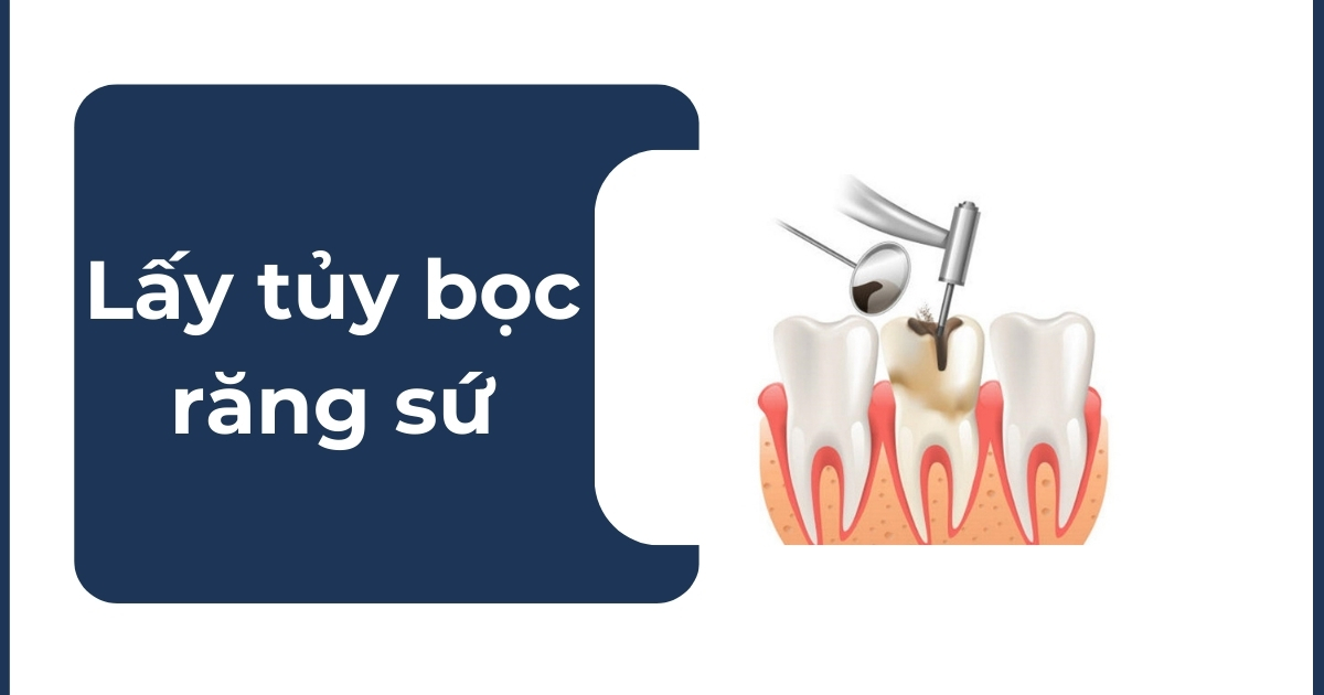Lấy tủy bọc răng sứ mất bao lâu? Quy trình, giá bao nhiêu?