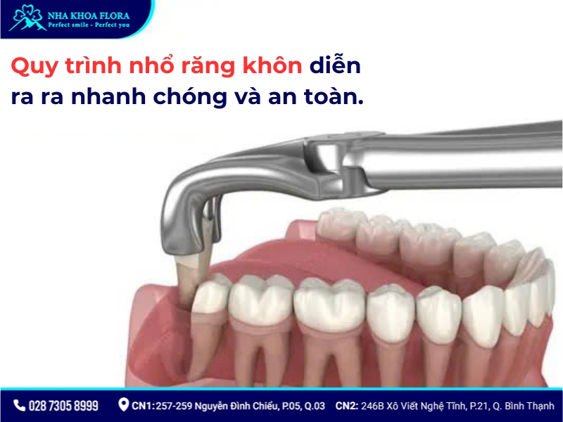 nhổ răng khôn