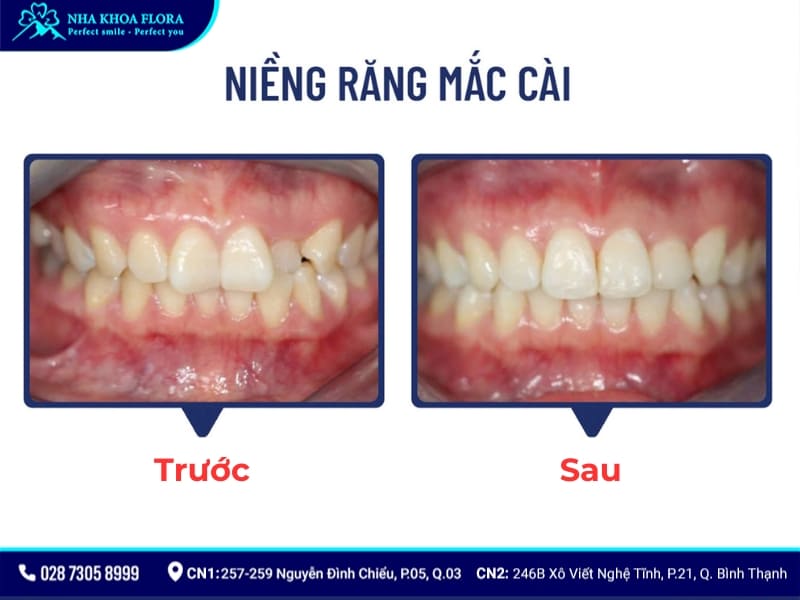 niềng răng bao nhiêu tiền