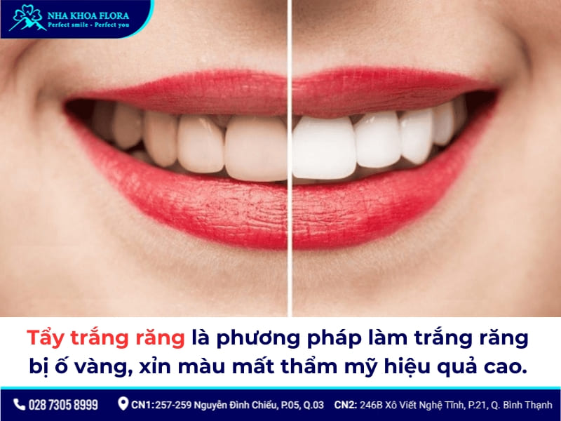 tẩy trắng răng