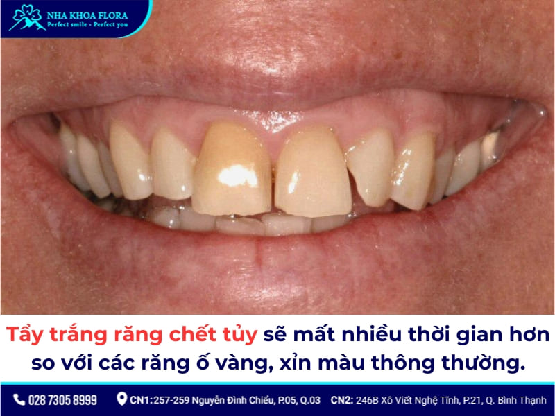 tẩy trắng răng