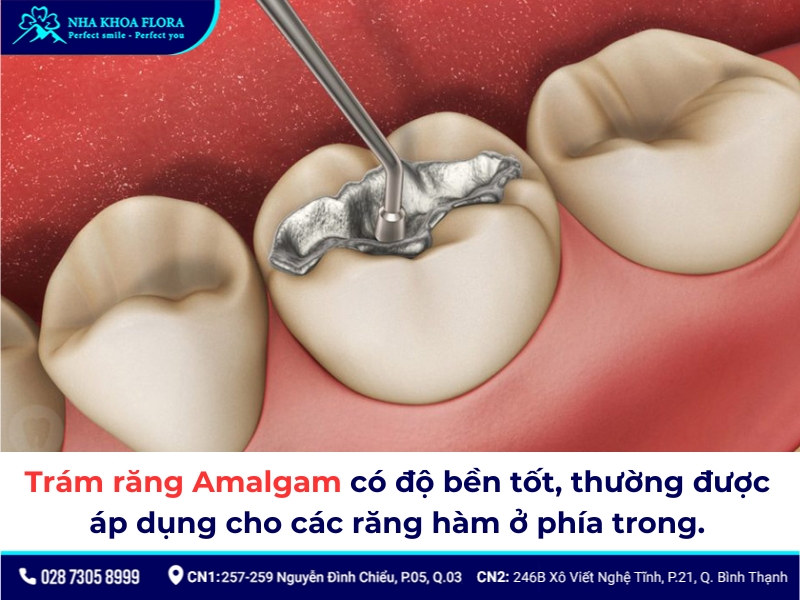 Trám răng Amalgam hiện nay ít được ưa chuộng so với vật liệu trám khác