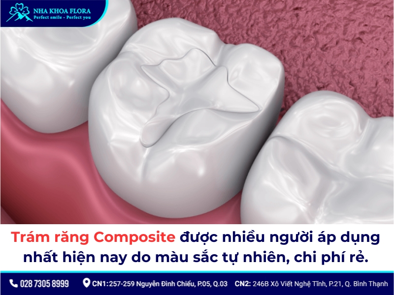 Trám răng Composite có ưu điểm là chi phí rẻ và thẩm mỹ tương đối tốt nên được nhiều người lựa chọn