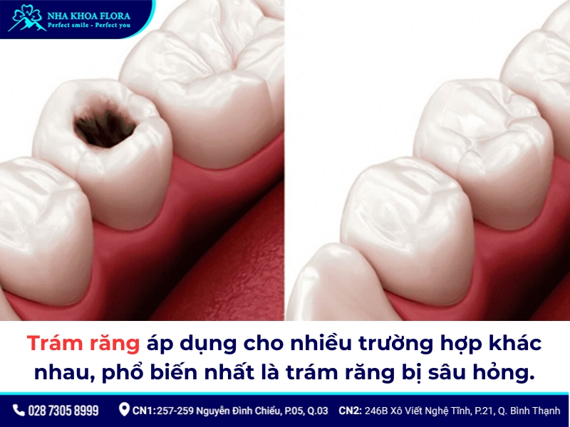Trám răng áp dụng cho nhiều tình trạng răng như sâu hỏng, sứt mẻ, thưa…