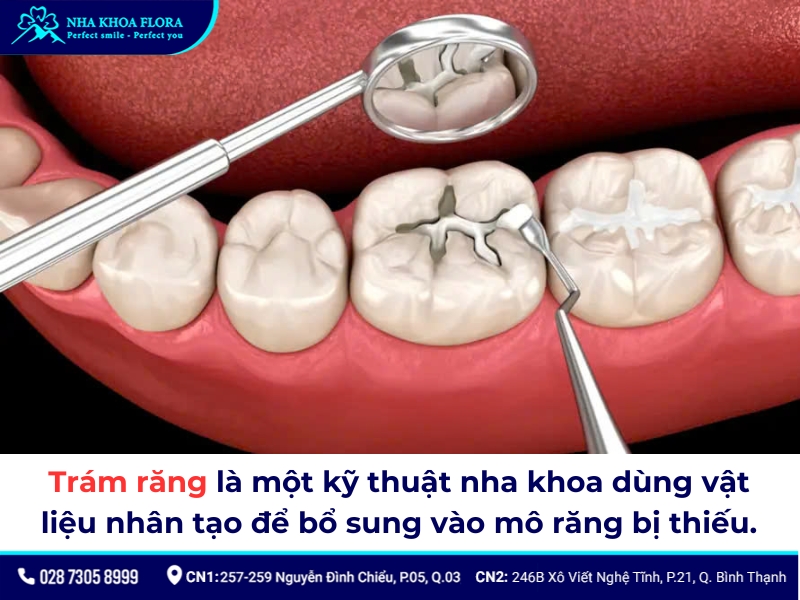 Trám răng là phương pháp không còn quá xa lạ với nhiều người hiện nay